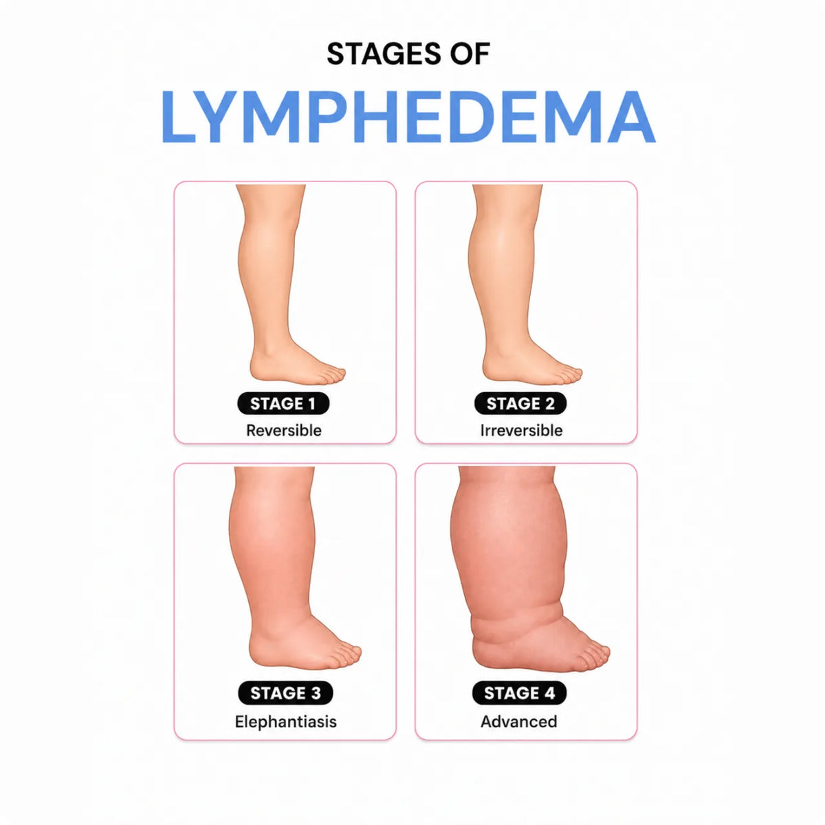 Chart showing the four stages of lymphedema